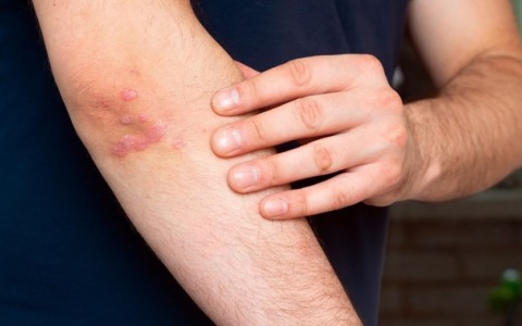 Sanremo: conferenza sulla psoriasi a Palazzo Roverizio