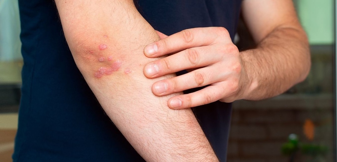 Sanremo: conferenza sulla psoriasi a Palazzo Roverizio